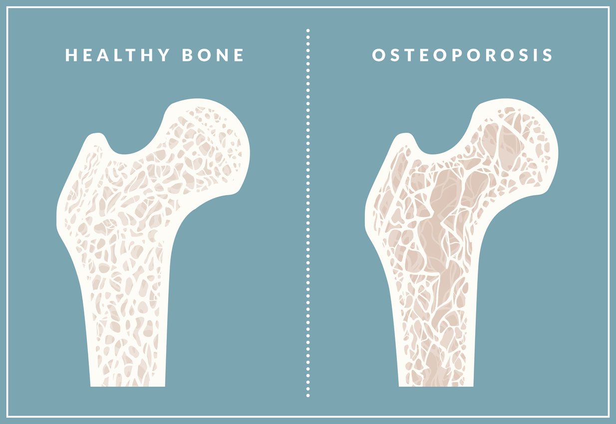 What Is Osteoporosis Painscale