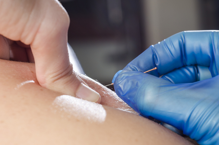 The Pros and Cons of Dry Needling