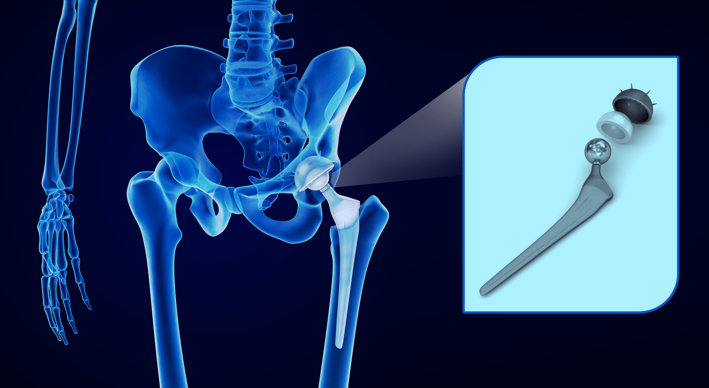 Risks and Benefits of Hip Replacement Surgery