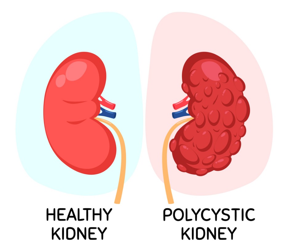 kidney failure clipart