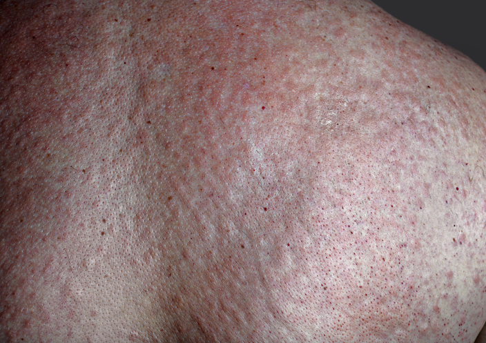 stevens johnson syndrome mild rash