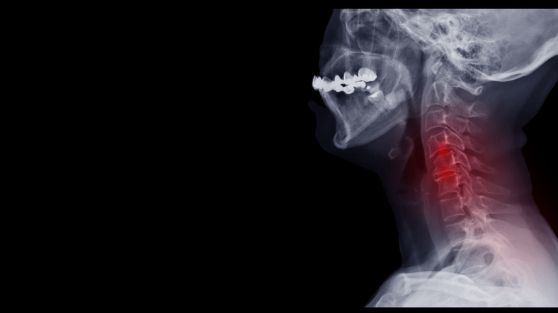 Grading Scales for Disc Degeneration and Regeneration: Clinical