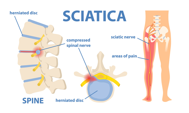 Progression and Possible Complications of Sciatica