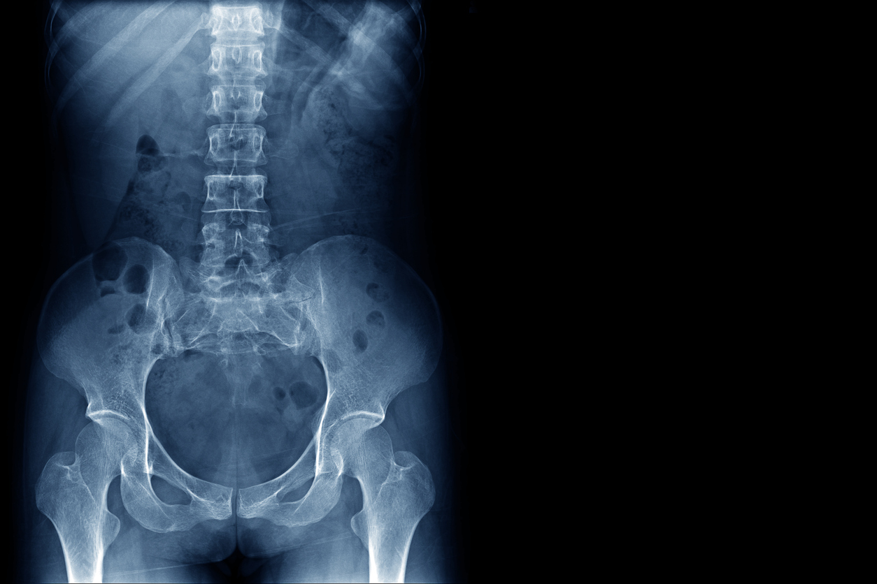 Spinal fusion - Mayo Clinic