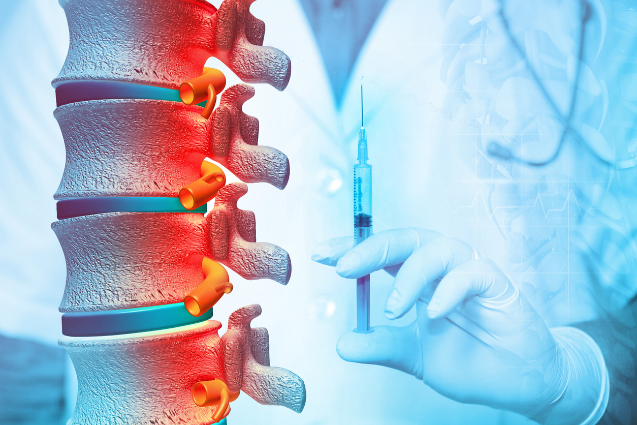 Scoliosis brace: MedlinePlus Medical Encyclopedia Image