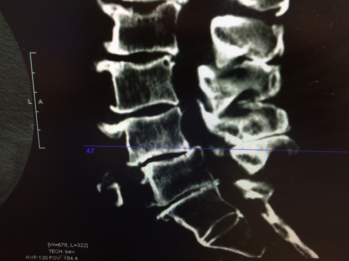 Conventional Treatments for Spinal Stenosis