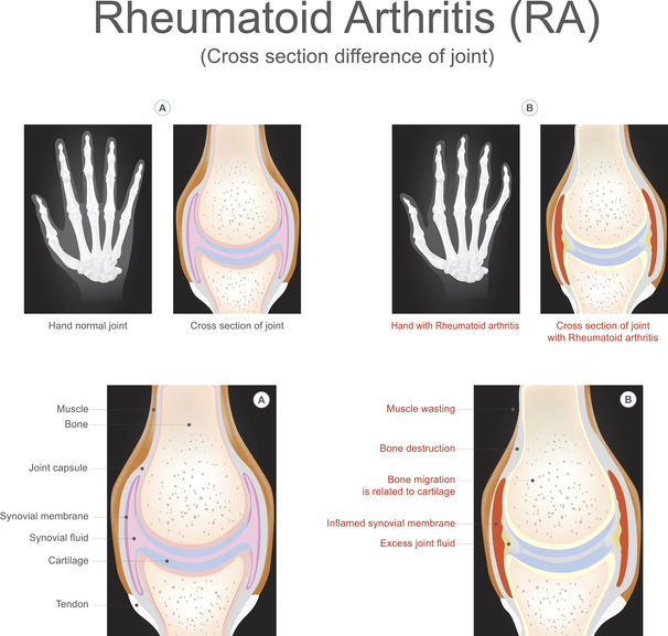 Effects of Rheumatoid Arthritis: Skeletal System, Immune, More