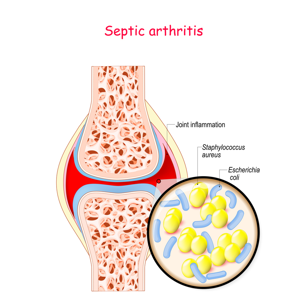 When and Why to Apply Cold to an Arthritic Joint