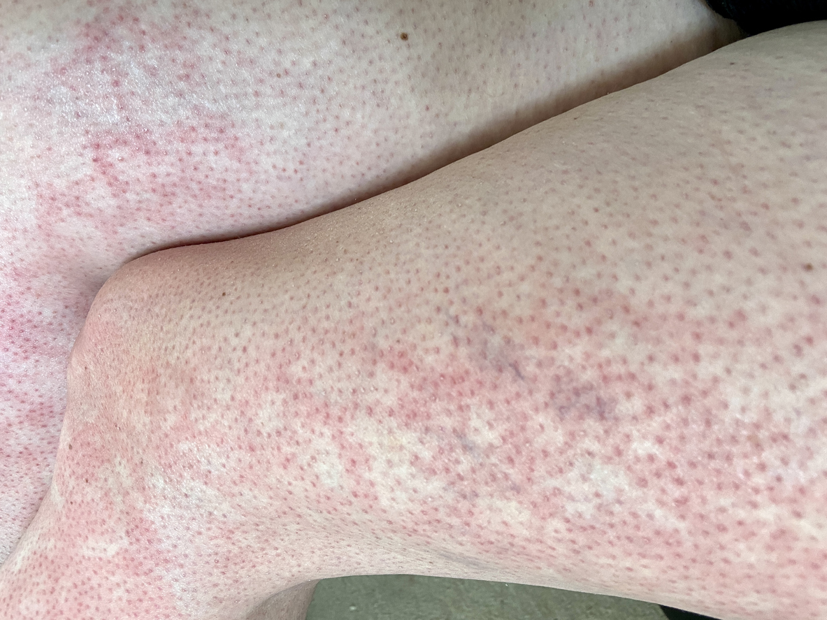 Hot water bottle warning: Dr Amir warns they can cause 'erythema ab igne'  or skin rash