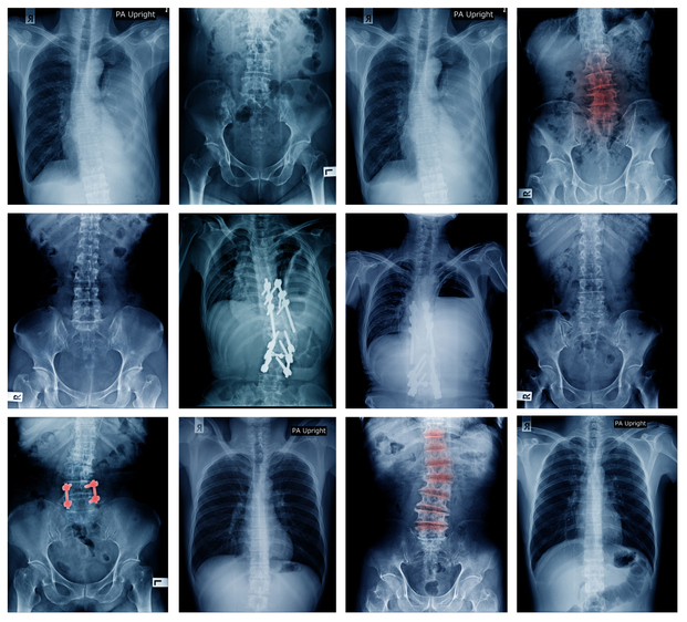 Foraminal Stenosis: What It Is, Symptoms, Types & Treatments