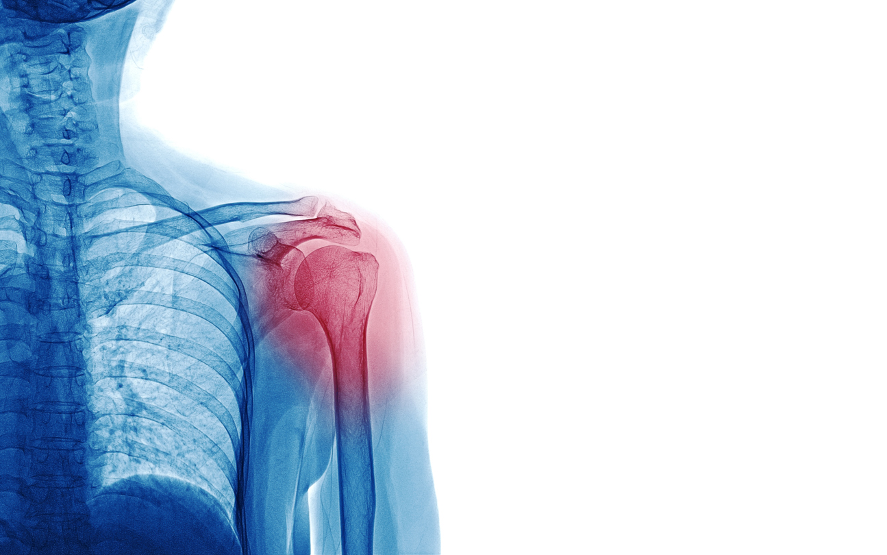 Who Is a Candidate for Shoulder Replacement Surgery?