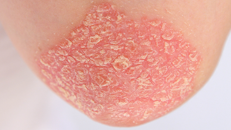 linear psoriasis