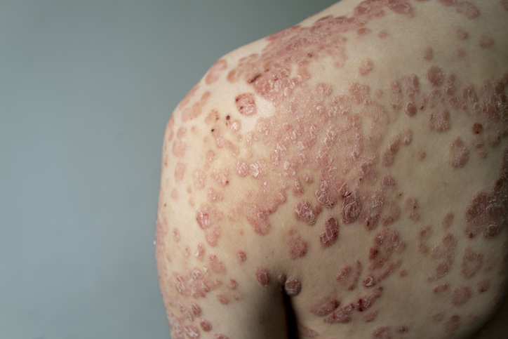 linear psoriasis