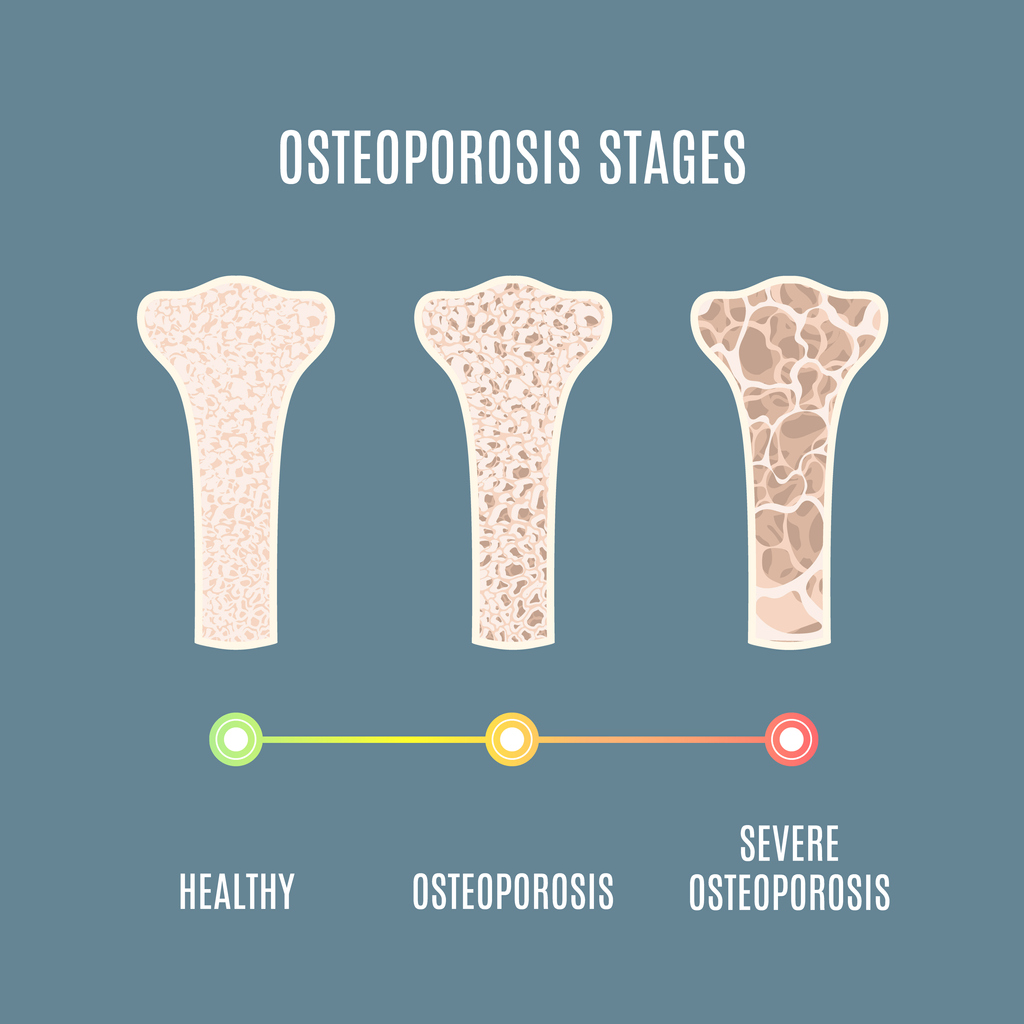 What Is The Stage Right Before Osteoporosis