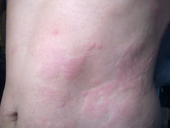 coping-with-hives-painscale