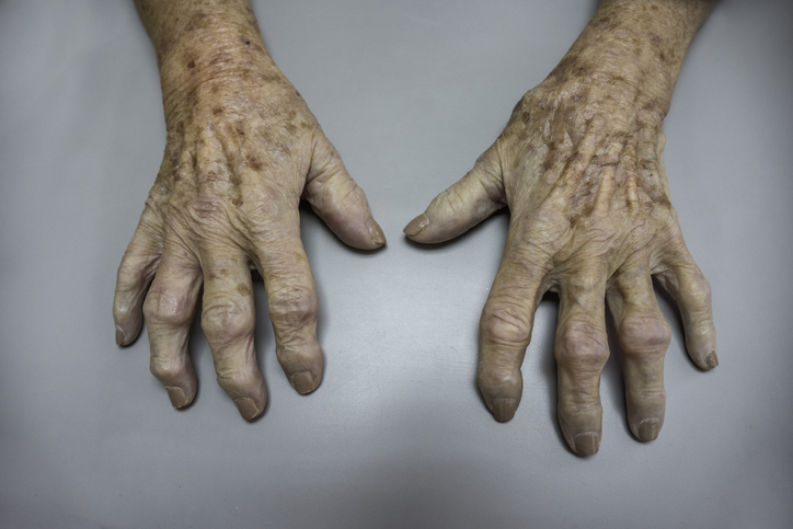 Osteoarthritis Hand